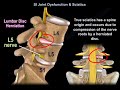 Sacroiliac join dysfunction  or Sciatica