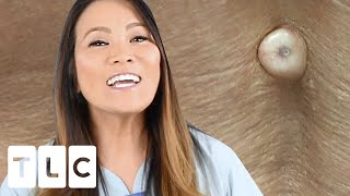 “You Can Pop Them Out Nicely”: A Spine-Tingling Cyst | Dr Pimple Popper: This Is Zit