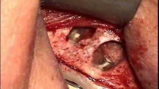 Dr. Jason Deblinger Root canal surgery! MICROSCOPIC APICOECTOMY!! Lower molar microapicoectomy!