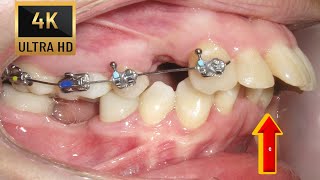 OVERJET in Adults ❗ Braces in 4 k resolution!