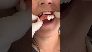 This flexible dental prosthesis is your solution #music #love #travel #viral #de