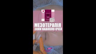 Мезотерапія 👀 періорбітальної зони препаратом  Dermaheal SB