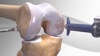 Cartilage Repair with Arthrex® BioCartilage® (Knee)