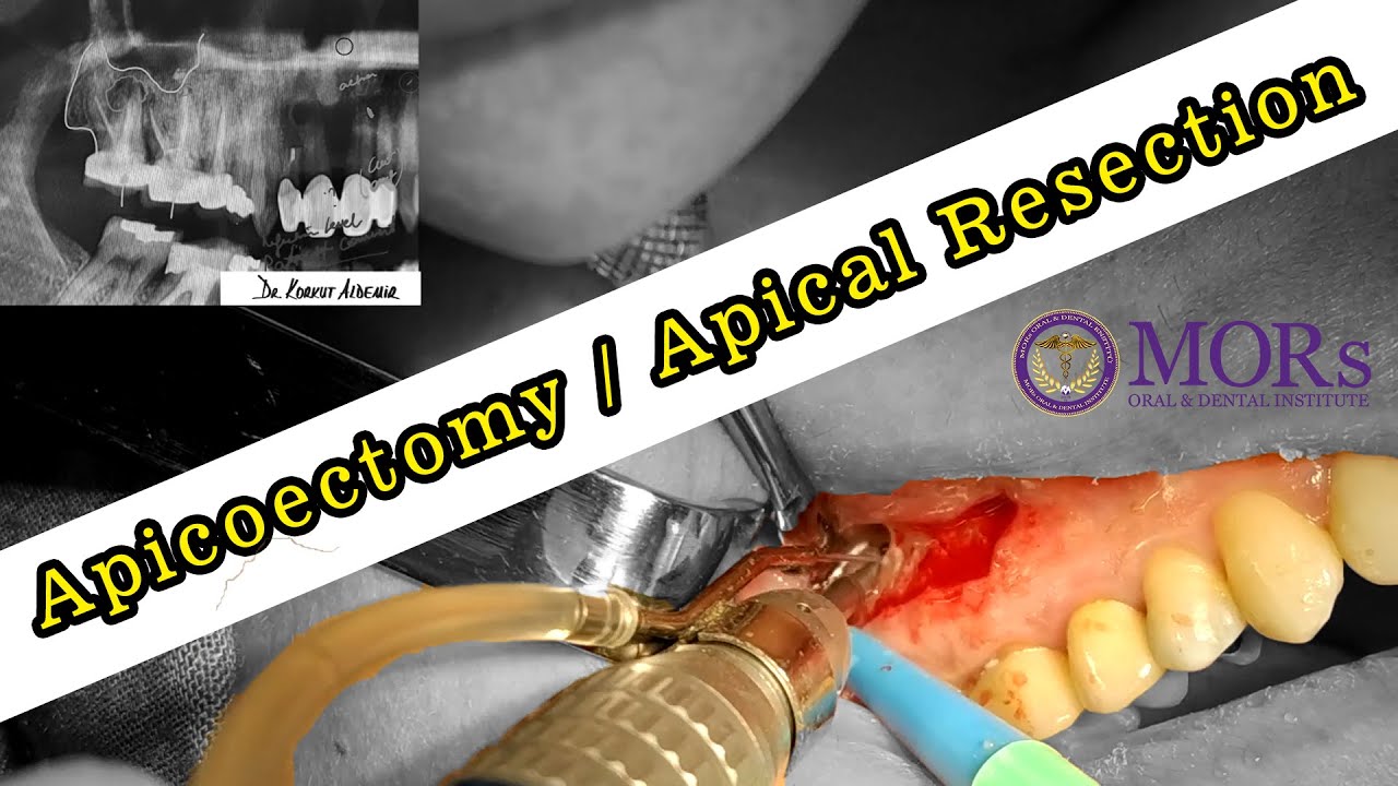 APICOECTOMY / Apical Resection ( Root Canal Surgery ) - YouTube