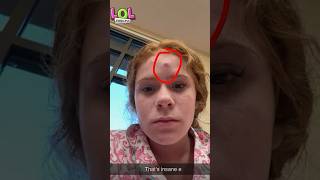 Harper’s Monster Zit!