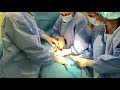 lindja cezariane cesarean birth