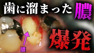 【閲覧注意】歯の根本に溜まった膿袋を爆発させてキレイに掃除します【歯医者の治療映像】膿栓