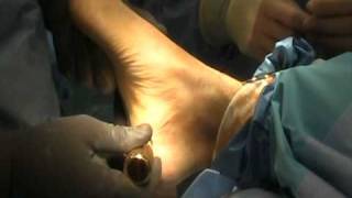 Endoscopic Plantar Fasciotomy Surgery | MYFOOTSHOP.COM