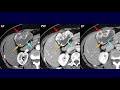 preview. a hypervascular tumor with cystic change