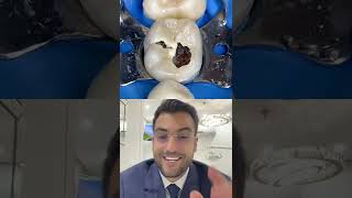 DENTISTA reage a dente COMPLETAMENTE CARIADO