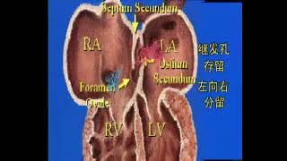 【高清重制】卫生部医学视听教材-介入放射学-JR006 先天性心脏病的介入治疗