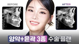 보고도 믿기 힘든 양악+윤곽3종 플랜