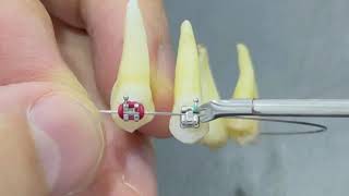 Self ligating braces  VS Traditional for both types metal #braces \u0026 #ceramic_braces #damonbraces