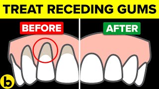 How To Treat Your Receding Gums At Home Naturally