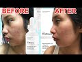 HOW TO USE THE ORDINARY NIACINAMIDE 10% + Zinc 1% | REVIEW 2020| Galy Gascon