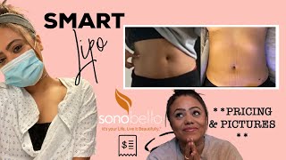 I GOT SMART LIPO WITH SONO BELLO! BEFORE \u0026 AFTER PICS [PART ONE]