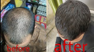 Hair Fall Baldness Ganjapan ब ल क ट टन Treatment