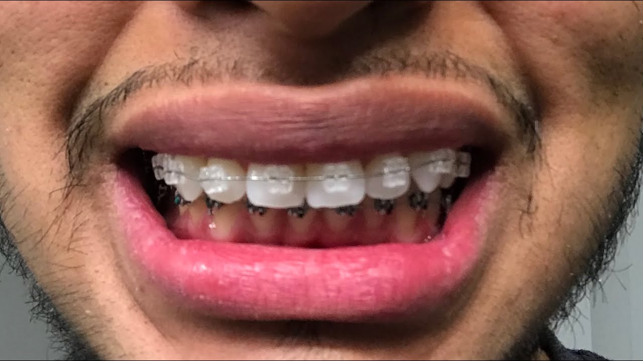 2 YEAR BRACES TIME LAPSE| DEEP OVER BITE | MUST SEE! - YouTube