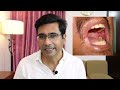 পান সুপারি থেকে মুখের রোগ oral submucous fibrosis