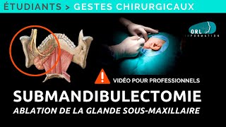 How to perform a submandibular gland resection | Step by Step procedure