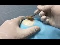 Big Cystic Acne Blackheads Extraction Blackheads & Milia, Whiteheads Removal Pimple Popping Part 1