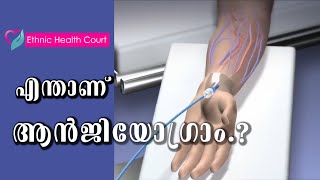 എന്താണ് ആൻജിയോഗ്രാം.? | Angiogram |  Ethnic Health Court