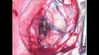 falx meningioma  removal