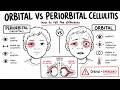 Orbital VS Periorbital Cellulitis