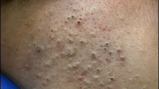 [ASMR] Satisfying Deep Pore Cleansing and Blackhead Extraction, Skincare Routine and Beauty Solution