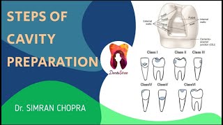 Steps of Cavity Preparation l Fundamentals of Tooth Preparation l Operative Dentistry