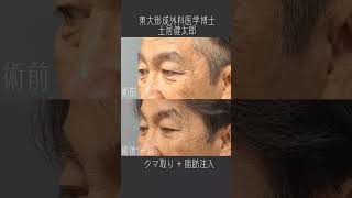 70代でもあきらめない若返り法　切らずに若くなる　 #クマ治療 #クマとり #美容外科 #脱脂 #脂肪注入 #新宿美容外科　効果の過不足、たるみ、腫れ、内出血、感染などのリスク。一回73万円〜