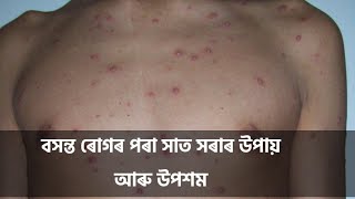 মাজু আই লক্ষণ প্ৰতিকাৰ প্ৰতিৰোধ  #chickenpox #symptoms #prevention