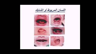 اللسان المربوط او الشابك لدي حديثي الولادة  (tongue tie)