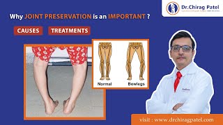 Say Goodbye to Bow Legs: Discover the Best Treatment ✅ | Joint Preservation Surgery