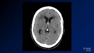 Neuroradiology board review lecture 1 case 11