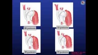 [Keynote lecture] Strategies for neurological protection in aortic arch surgery