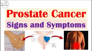 Prostate Cancer Signs and Symptoms (Urinary, Sexual & Metastatic Symptoms)