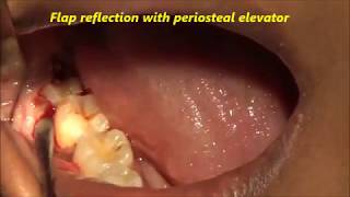 Distoangular lower wisdom tooth removal with elevator