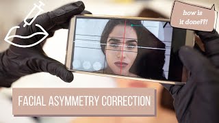 Facial Asymmetry Correction | Lip Filler