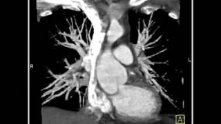 4D Imaging of the Aortic Valve: 3D and 4D Evaluation of the Aorta and Aortic Root (2 of 5)