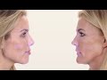 galderma restylane family of products aspire visualizer