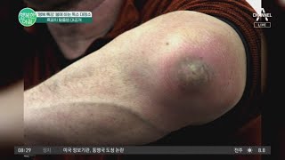 다가오는 여름! 흑꿈치(팔꿈치가 검은)를 피해라 | 행복한 아침 11077 회