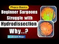 Most Common Mistakes during Hydrodissection Beginner Surgeon.(Phaco Basics) - Dr. Deepak Megur