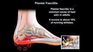 Plantar Fasciitis - Everything You Need To Know - Dr. Nabil Ebraheim