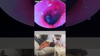 Doctor Pulls Live Insect from Patient's Ear! 🦗👂 #animals #microfacts