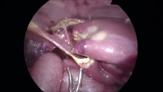 Laparoscopic excision of large HEPATIC CYST in 6-day-old female infant