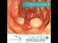 colonoscopia