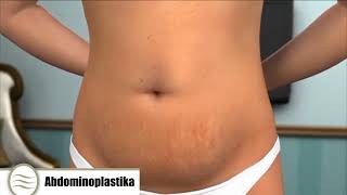 Abdominoplastika - kur shërben