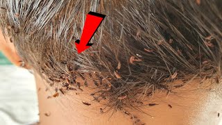 Extremely damaged giant lice from short hair - Lice removal