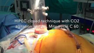 Laparoscopic peritonectomy for limited and low grade pseudomyxoma with a CO2 HIPEC delivery system